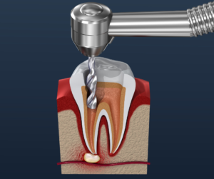 root canal