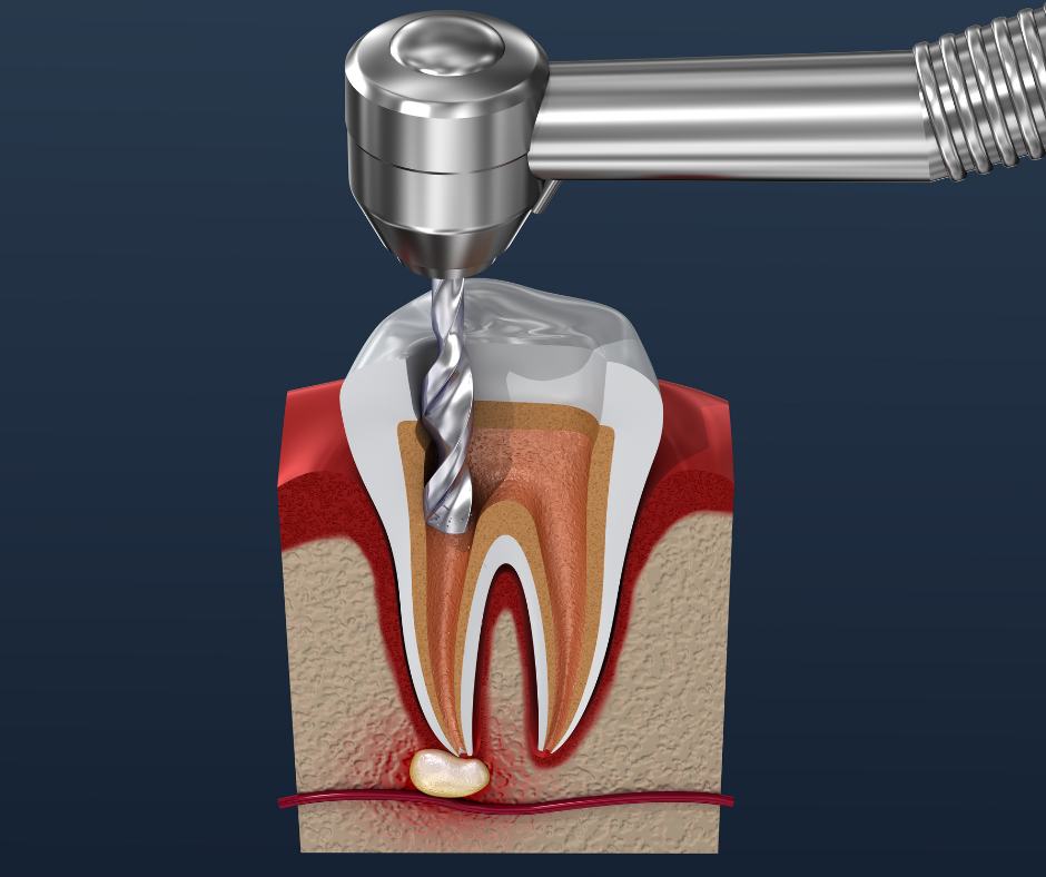 root-canal-or-tooth-extraction-pros-and-cons-the-endo-house